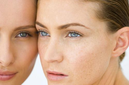 去斑的方法有哪些