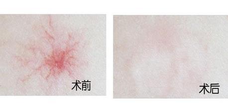 告诉你长蜘蛛痣的原因是什么