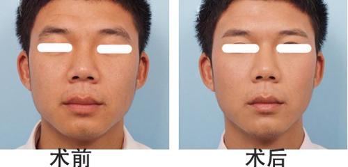 <a href=http://www.mx185.com/listinfo-655-0.html target=_blank class=infotextkey>切眉</a>手术后老得快
