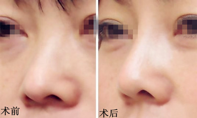 不良<a href=http://www.mx185.com/listinfo-737-0.html target=_blank class=infotextkey>隆鼻</a>修复手术的方法