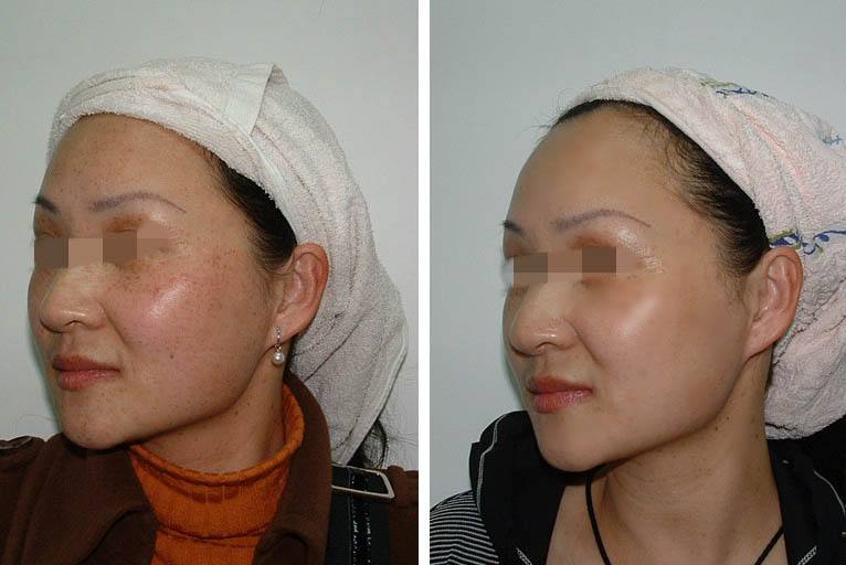 雀斑手术要多少钱