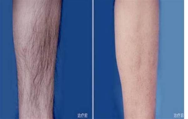 激光脱腿毛多少钱呢