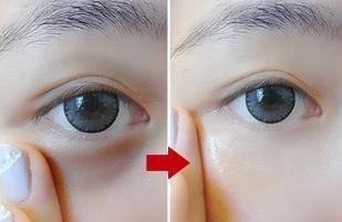 眼袋抽脂有后遗症吗