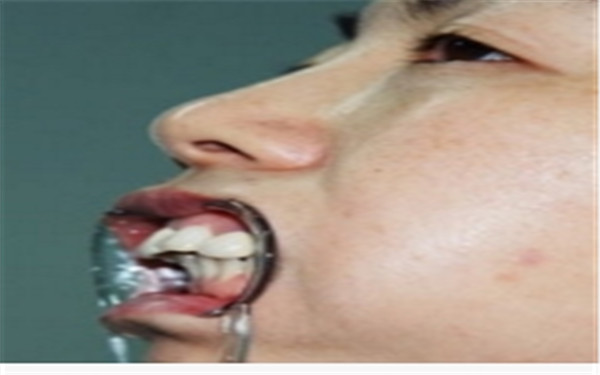 上颌整形手术过程