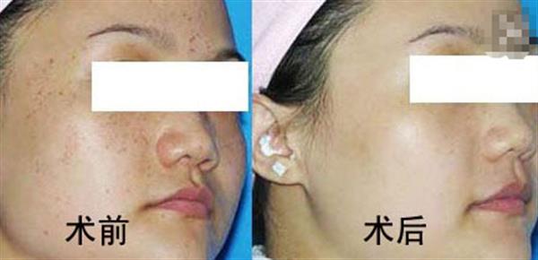 广州去黄褐斑方法哪种有效