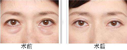 不适合做眼袋抽脂的禁忌人群