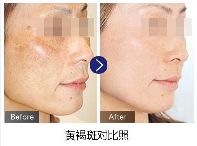 激光去黄有没有副作用