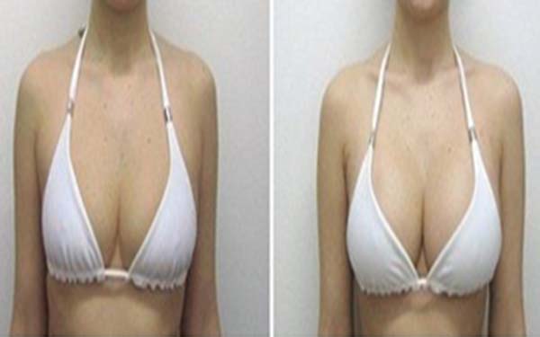 注射<a href=http://www.mx185.com/listinfo-618-0.html target=_blank class=infotextkey>隆胸</a>整形的医院