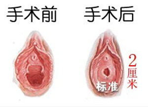 处女膜修复前后对比图