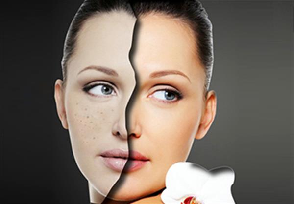 激光祛晒斑的禁忌人群有哪些