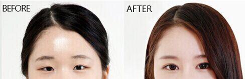 韩式重睑术多少钱