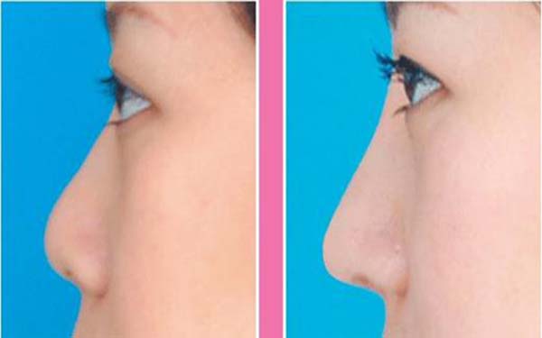 北京哪里<a href=http://www.mx185.com/listinfo-737-0.html target=_blank class=infotextkey>隆鼻</a>修复好