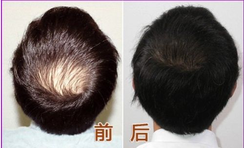 常见值发术后的护理方法
