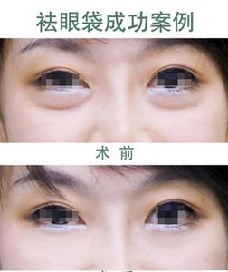 眼袋抽脂手术效果怎么样  