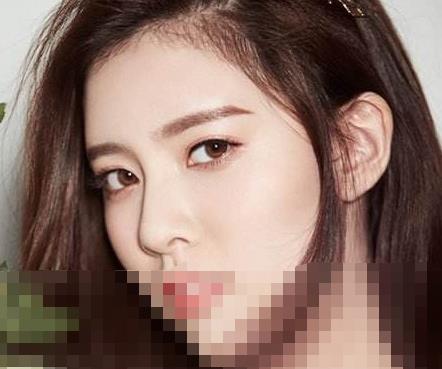 眼袋抽脂几天能恢复