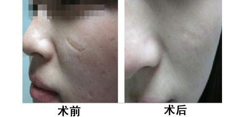 烫伤植皮有什么后遗症