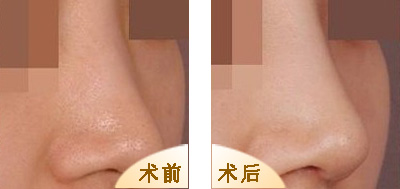 自体脂肪<a href=http://www.mx185.com/listinfo-737-0.html target=_blank class=infotextkey>隆鼻</a>的优缺点