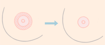 贵州乳晕胸部整形手术安全吗