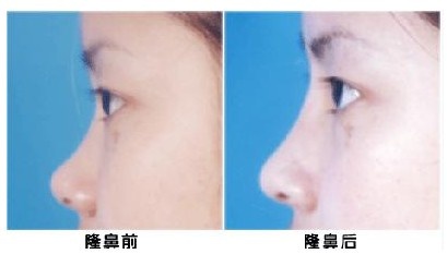 武汉<a href=http://www.mx185.com/listinfo-737-0.html target=_blank class=infotextkey>隆鼻</a>修复手术的价格