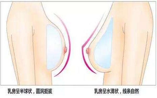 妙桃晴面假体<a href=http://www.mx185.com/listinfo-618-0.html target=_blank class=infotextkey>隆胸</a>的4大特点