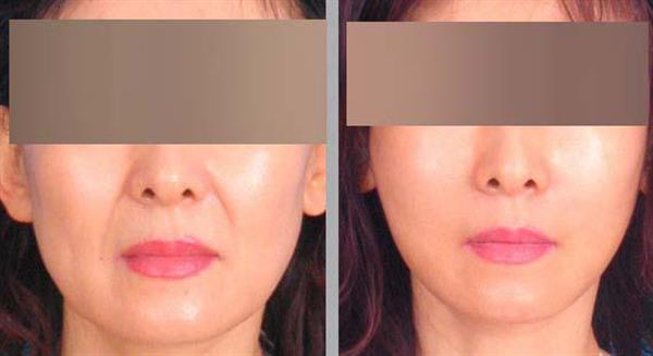 3大<a href=http://www.mx185.com/listinfo-614-0.html target=_blank class=infotextkey>除皱</a>术效果怎么样