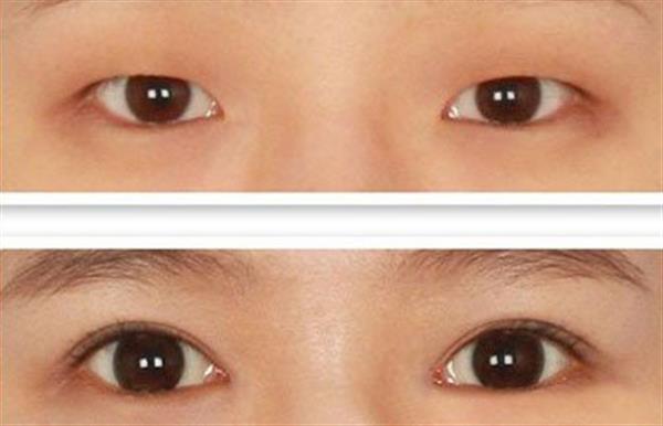 割<a href=http://www.mx185.com/listinfo-724-0.html target=_blank class=infotextkey>双眼皮</a>几个月定型