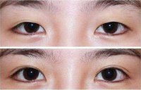 有关切开<a href=http://www.mx185.com/listinfo-724-0.html target=_blank class=infotextkey>双眼皮</a>的术前准备