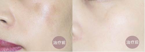 opt光子嫩肤原理