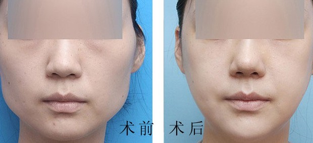 <a href=http://www.mx185.com/listinfo-629-0.html target=_blank class=infotextkey>下颌角</a>手术特点是什么