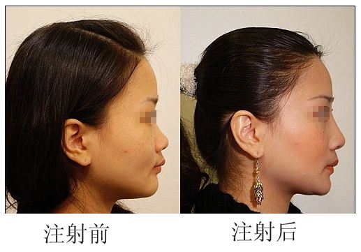 透明质酸<a href=http://www.mx185.com/listinfo-737-0.html target=_blank class=infotextkey>隆鼻</a>后要注意什么