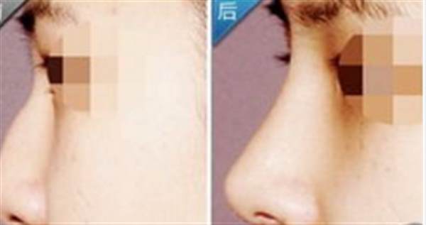 硅胶<a href=http://www.mx185.com/listinfo-737-0.html target=_blank class=infotextkey>隆鼻</a>排异哪些特点