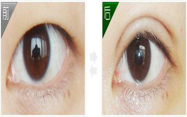 哪个季节割<a href=http://www.mx185.com/listinfo-724-0.html target=_blank class=infotextkey>双眼皮</a>较好?