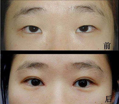 韩式切开法就是全切吗