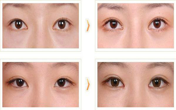 哪些人不适合做<a href=http://www.mx185.com/listinfo-724-0.html target=_blank class=infotextkey>双眼皮</a>?