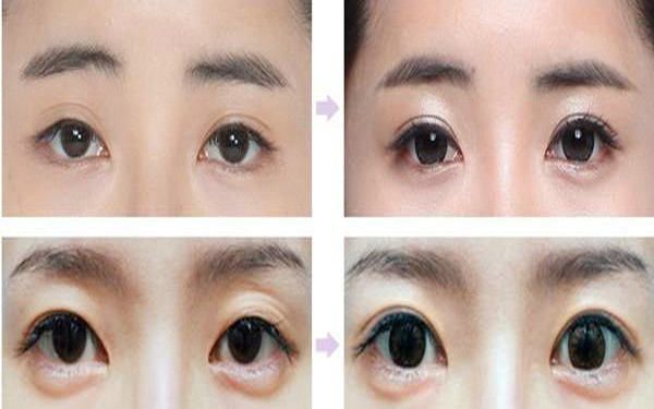 纳米<a href=http://www.mx185.com/listinfo-724-0.html target=_blank class=infotextkey>双眼皮</a>多久能化妆?