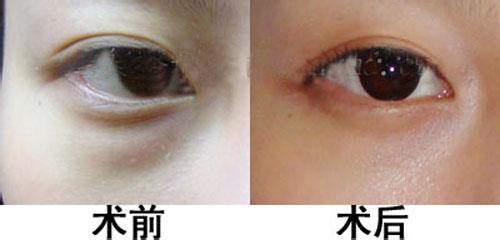 内切眼袋副作用