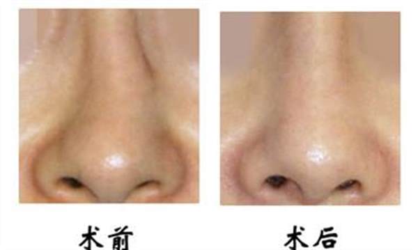 <a href=http://www.mx185.com/listinfo-751-0.html target=_blank class=infotextkey>歪鼻矫正</a>手术的后遗症及禁忌
