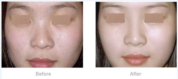 歪鼻用软骨矫正的效果及特点