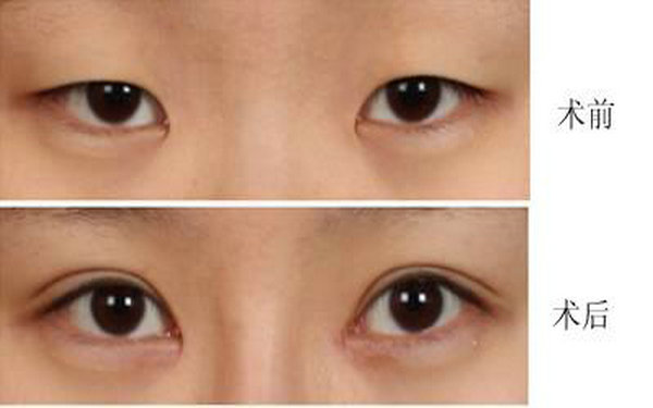 纳米无痕<a href=http://www.mx185.com/listinfo-724-0.html target=_blank class=infotextkey>双眼皮</a>禁忌?