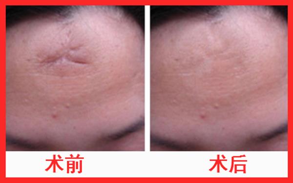 凹陷疤痕消磨术有用吗