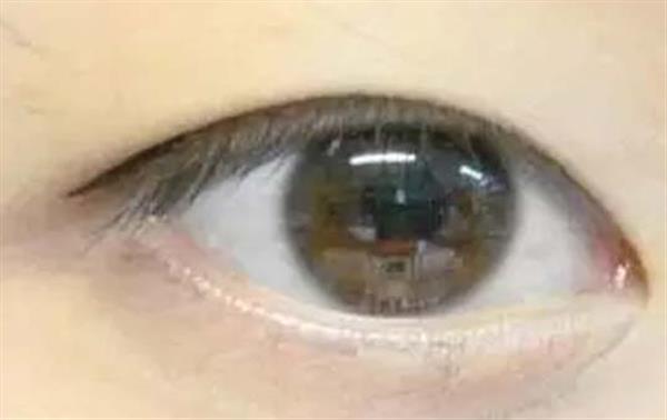 内切眼袋手术后的恢复期