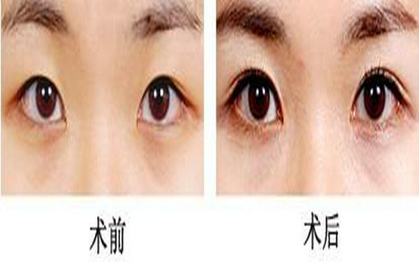 内双割什么<a href=http://www.mx185.com/listinfo-724-0.html target=_blank class=infotextkey>双眼皮</a>好看?