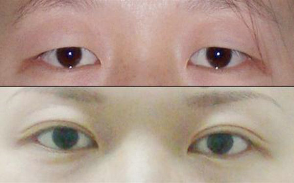 切开<a href=http://www.mx185.com/listinfo-724-0.html target=_blank class=infotextkey>双眼皮</a>会留疤吗?