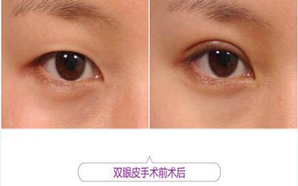 切开<a href=http://www.mx185.com/listinfo-724-0.html target=_blank class=infotextkey>双眼皮</a>几天拆线?