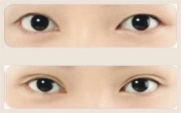 切<a href=http://www.mx185.com/listinfo-724-0.html target=_blank class=infotextkey>双眼皮</a>恢复时间