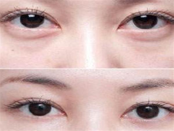 眼袋大怎么回事可以治疗吗