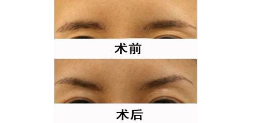 眉弓去薄术哪里可以做