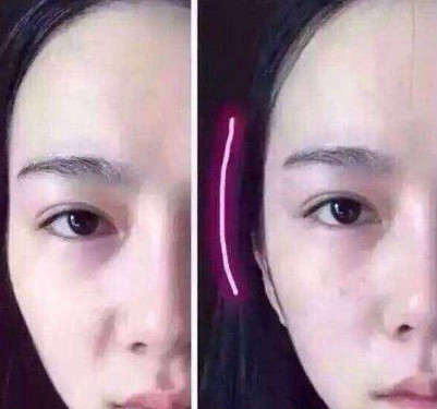 面部整形后不能吃东西吗