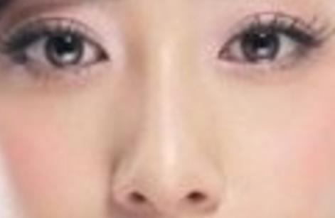 打了溶解酶多久消肿