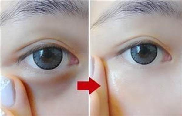 切完眼袋多长时间恢复